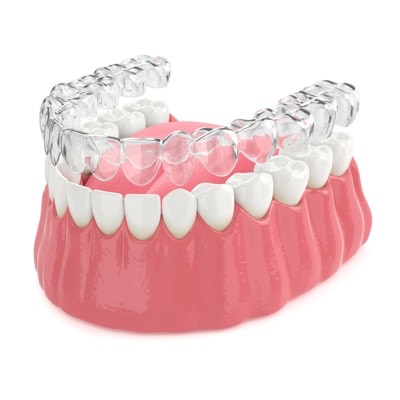 appareillage par gouttières transparentes amovibles