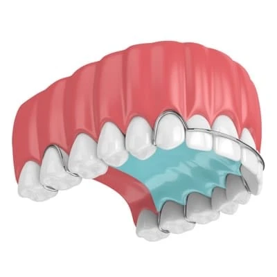 appareil orthodontique amovible